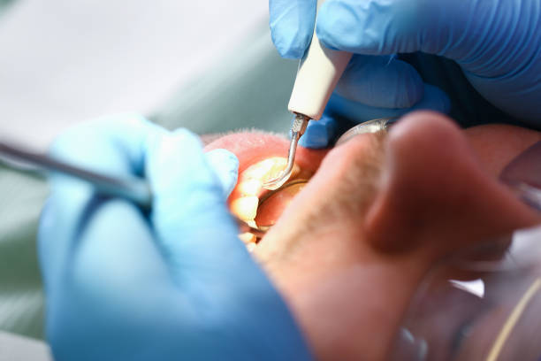 Best Emergency Dental Care for Broken or Chipped Teeth in Perryville, MD