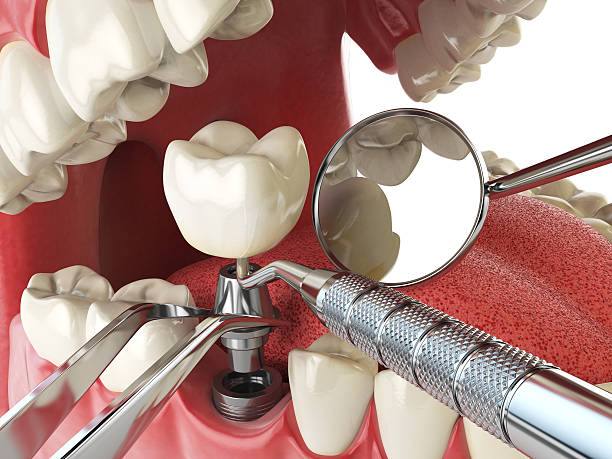 Best Emergency Tooth Extraction in Perryville, MD